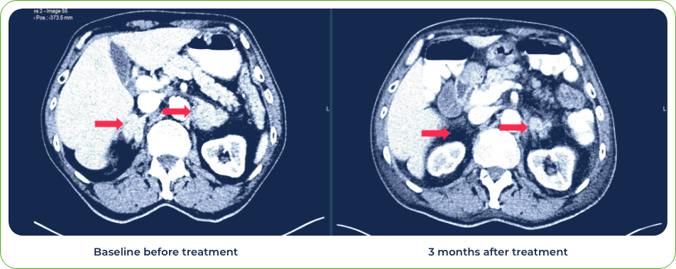 Brain scan - 3 months after treatment