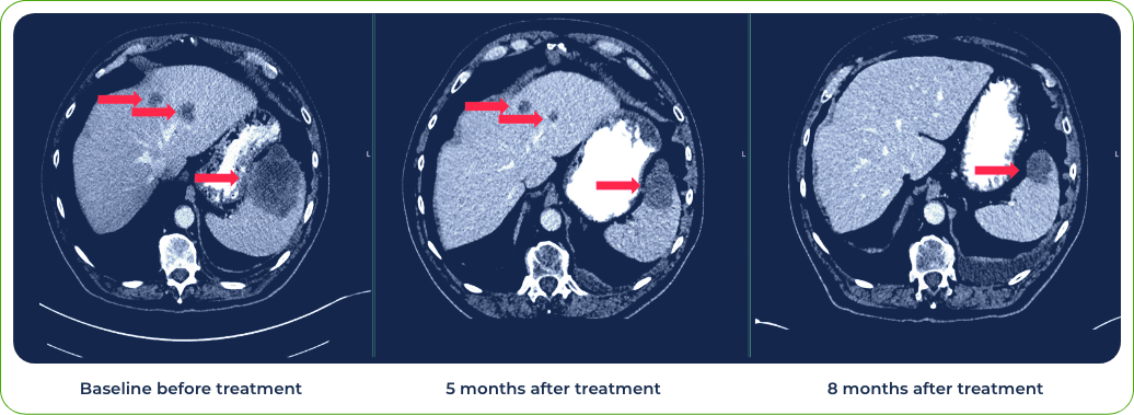 5 months after treatment